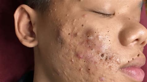 videoAcne Treatment Huong Da Nang524 2023Linkhttpsyoutu. . Huong acne